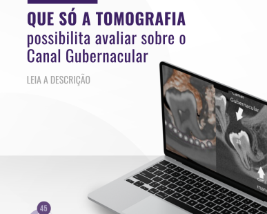 achados-sobre-o-canal-gubernacular