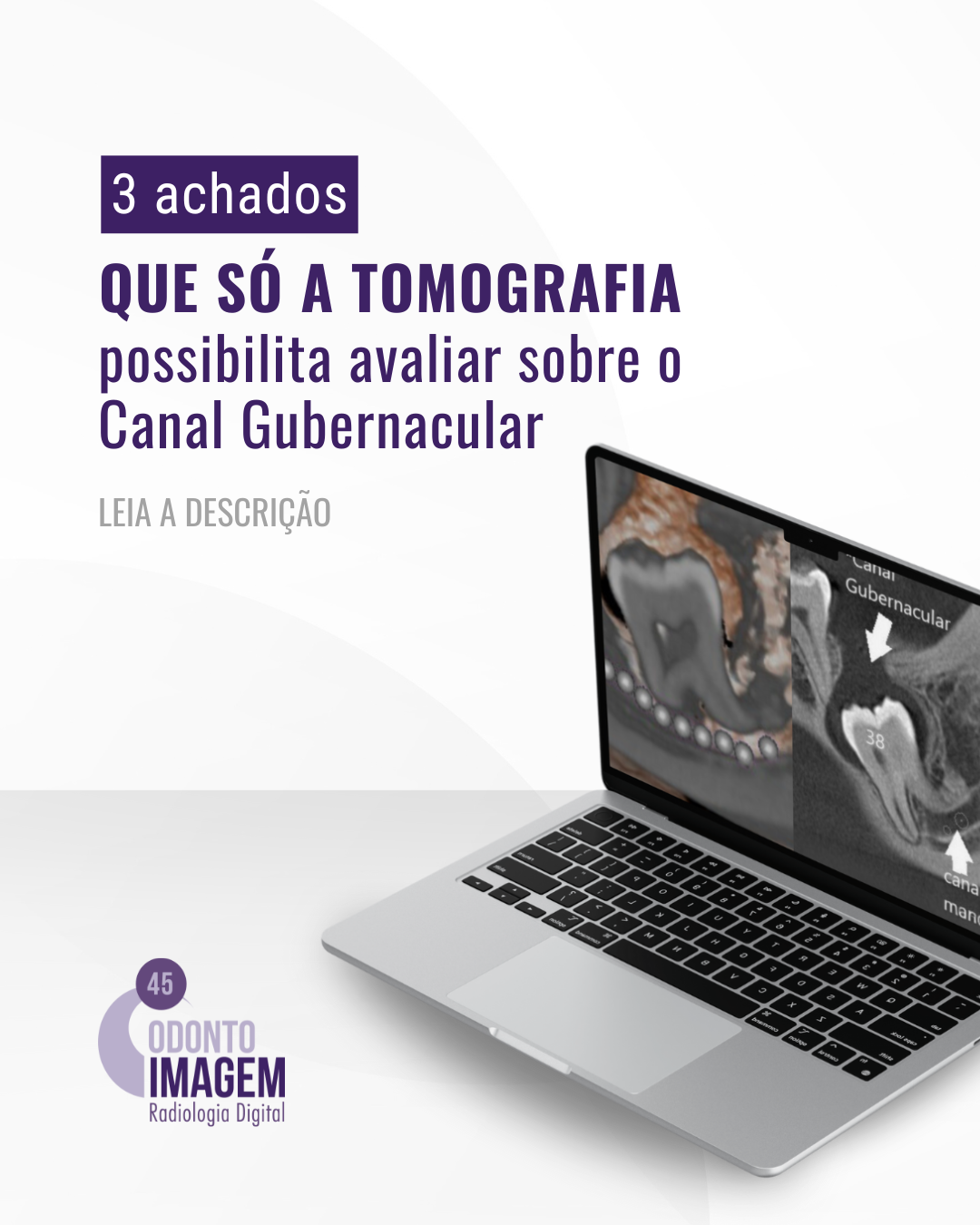achados-sobre-o-canal-gubernacular